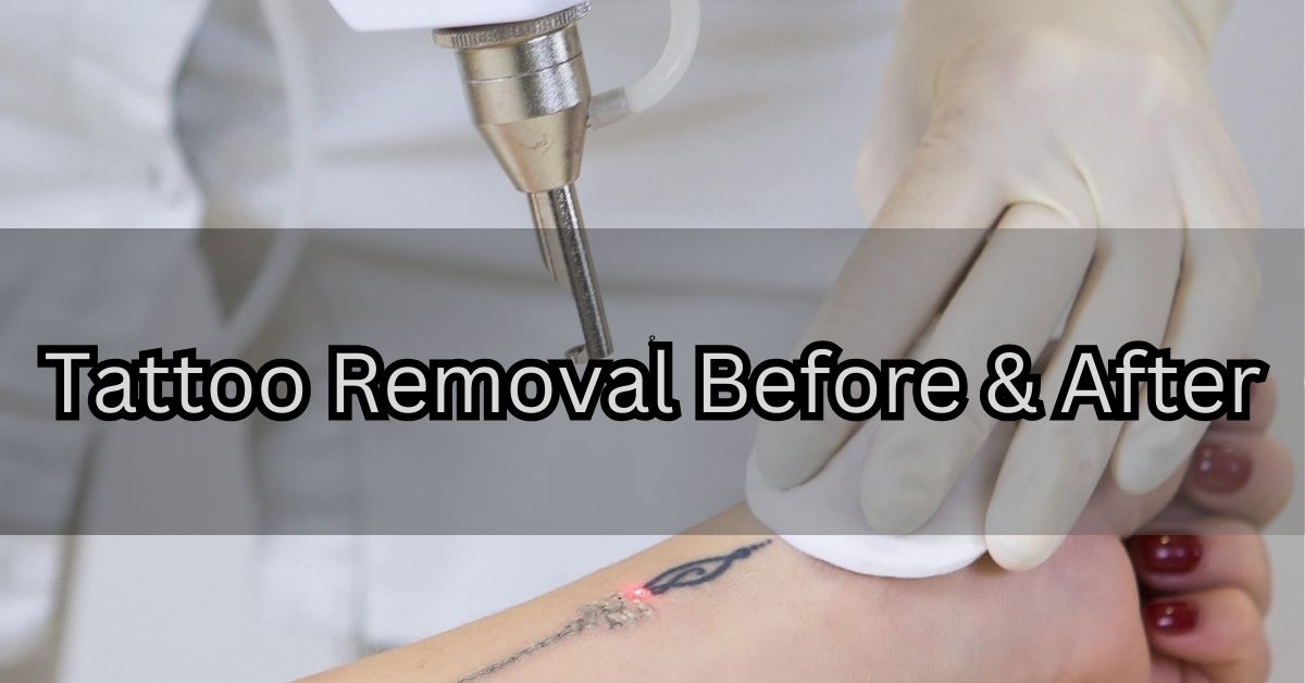 Features image of Tattoo Removal Before & After