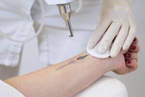 Laser tattoo removal by maestro tattoo