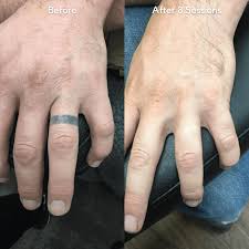 Tattoo removal before and after picture by maestro tattoo