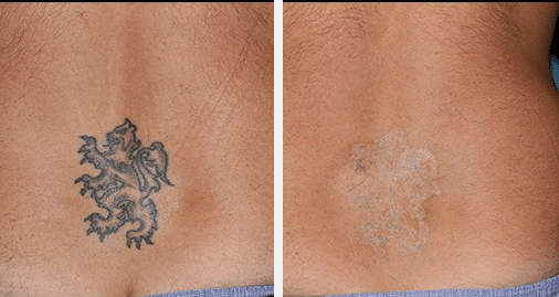 Tattoo Removal Before & After