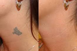 neck tattoo removal 1 by maestro tattoo