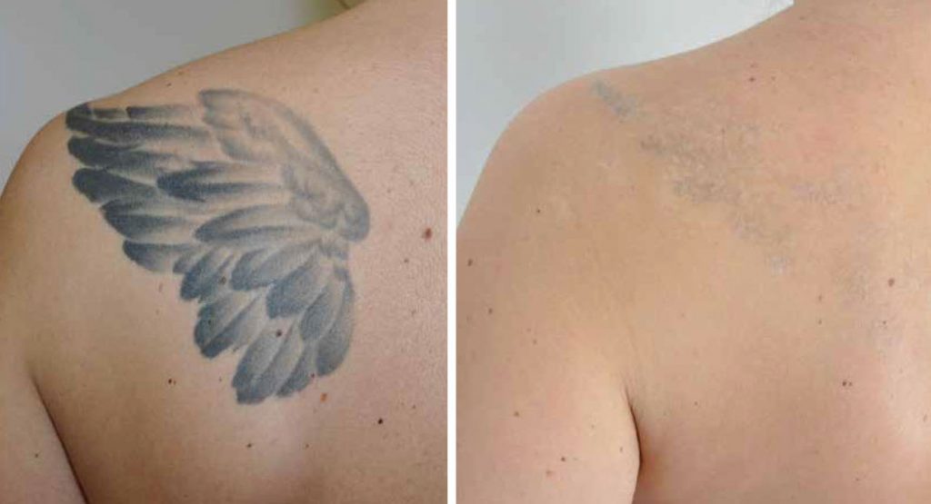 shoulder tattoo removal picture by maestro tattoo